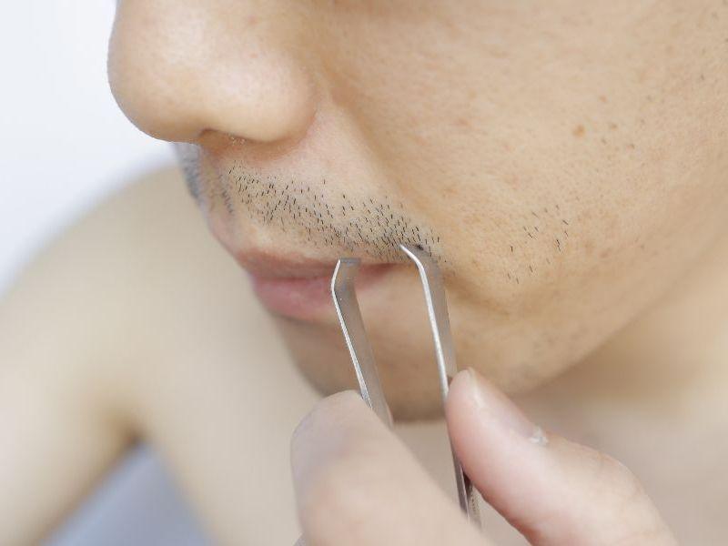 Nhổ râu tạo nên những vết thâm khá mất thẩm mỹ