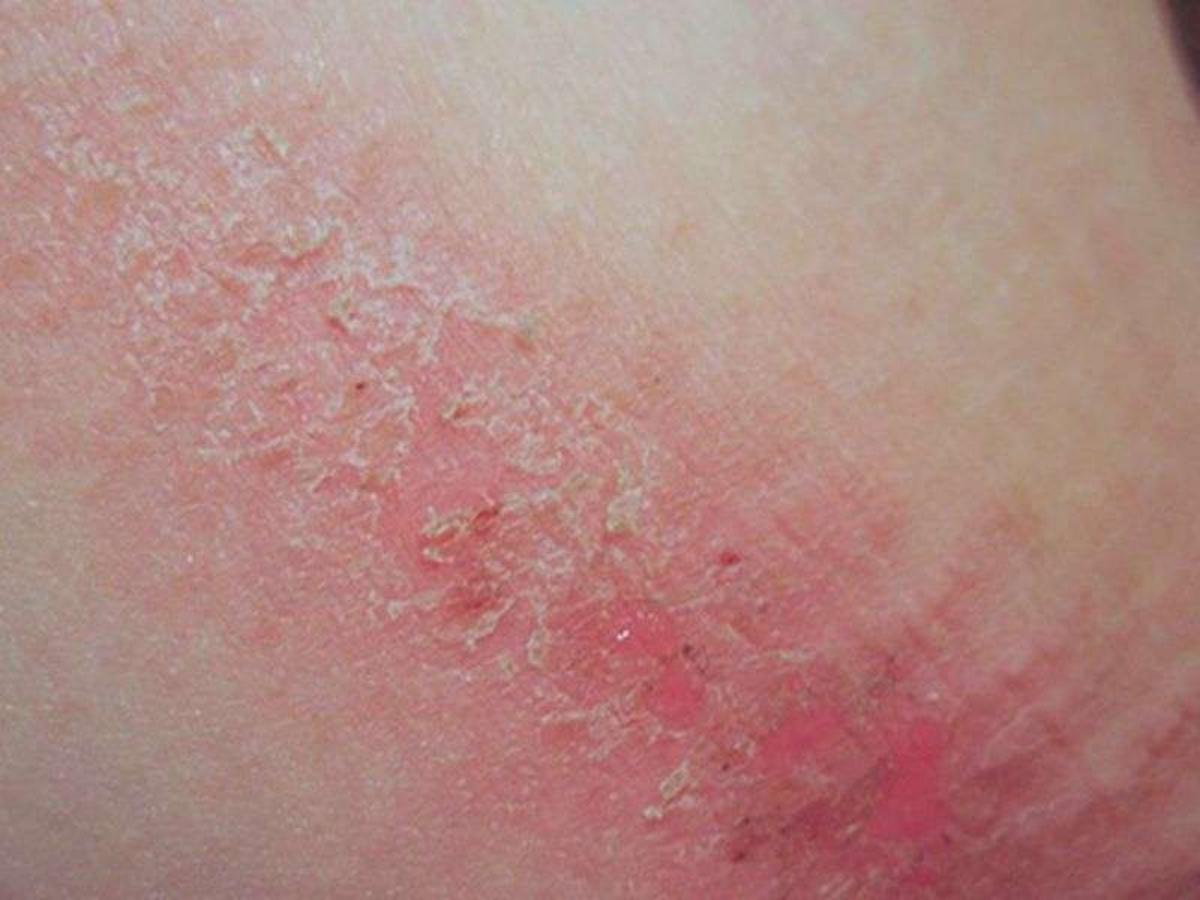 Chafing là da bị trầy xước do ma sát trong quá trình vận động