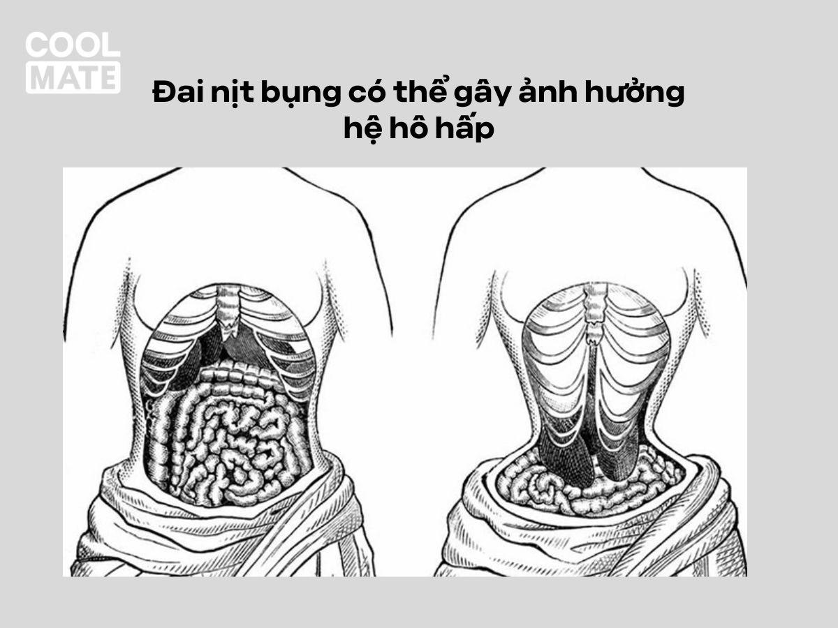 Đai nịt bụng có thể gây ảnh hưởng đến hệ hô hấp và tiêu hóa