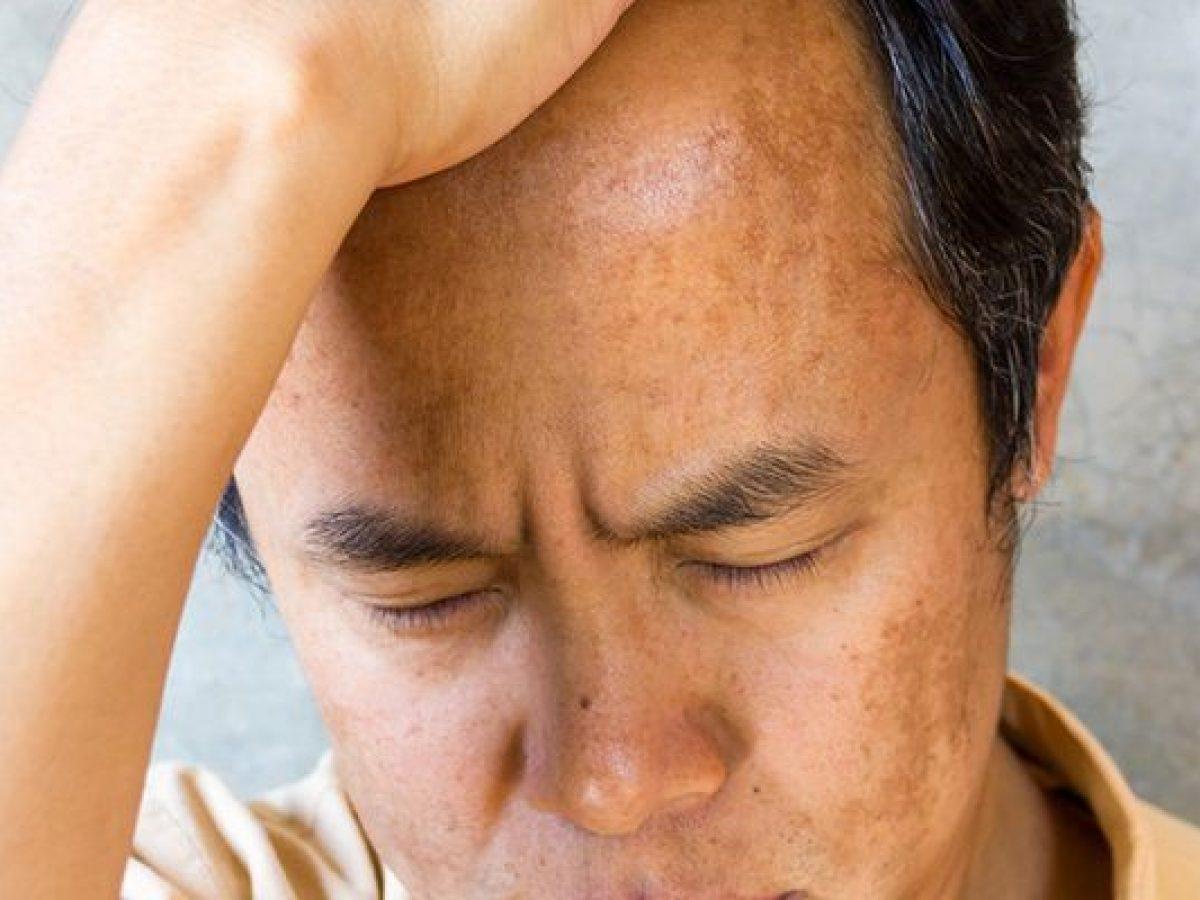 Da sạm đen là da có các mảng Melanin tăng cao gây sạm, không đều màu
