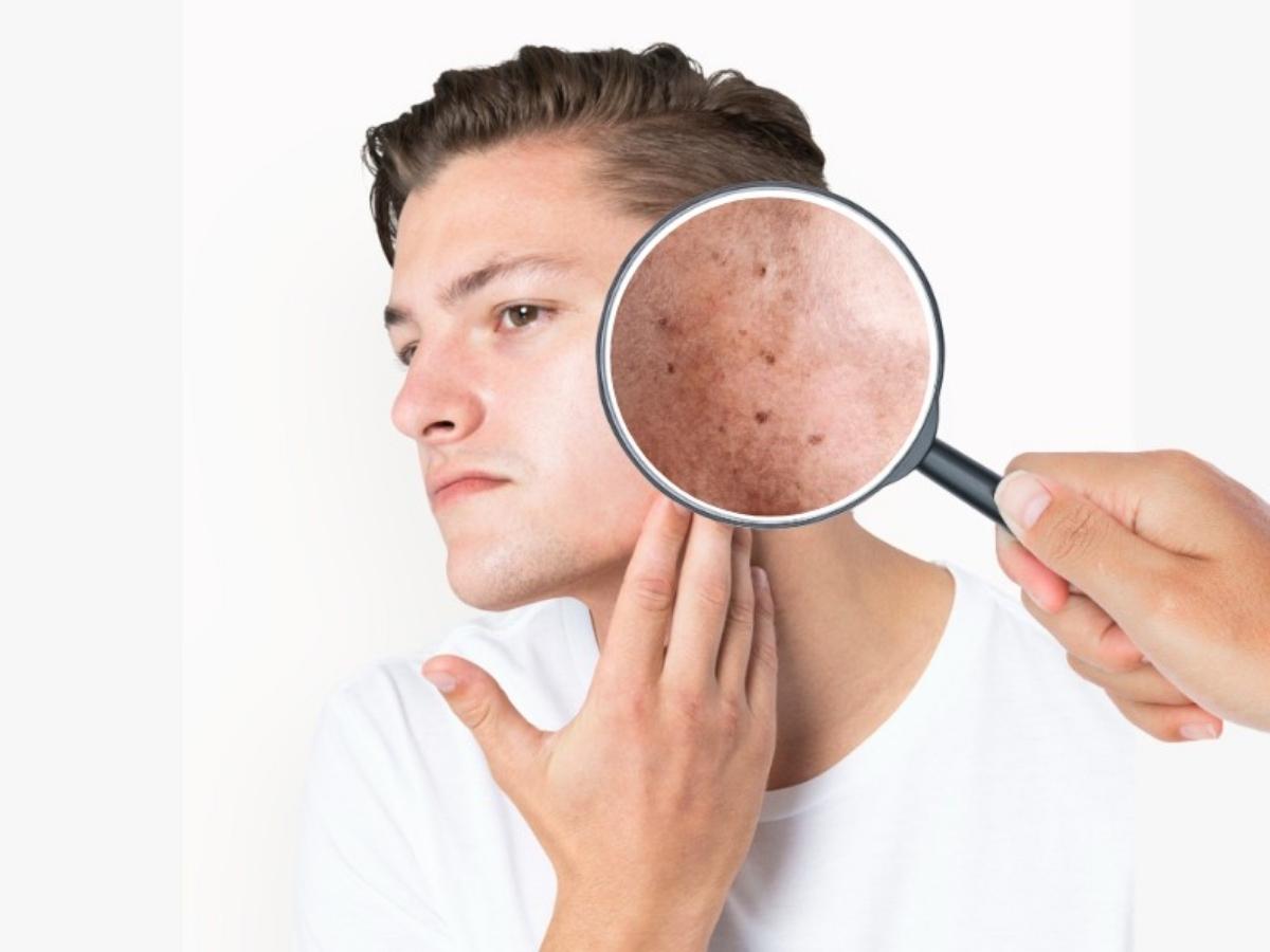 Tia UVA/UVB tác động làm tăng Melanin và phá hủy collagen trên da nam giới