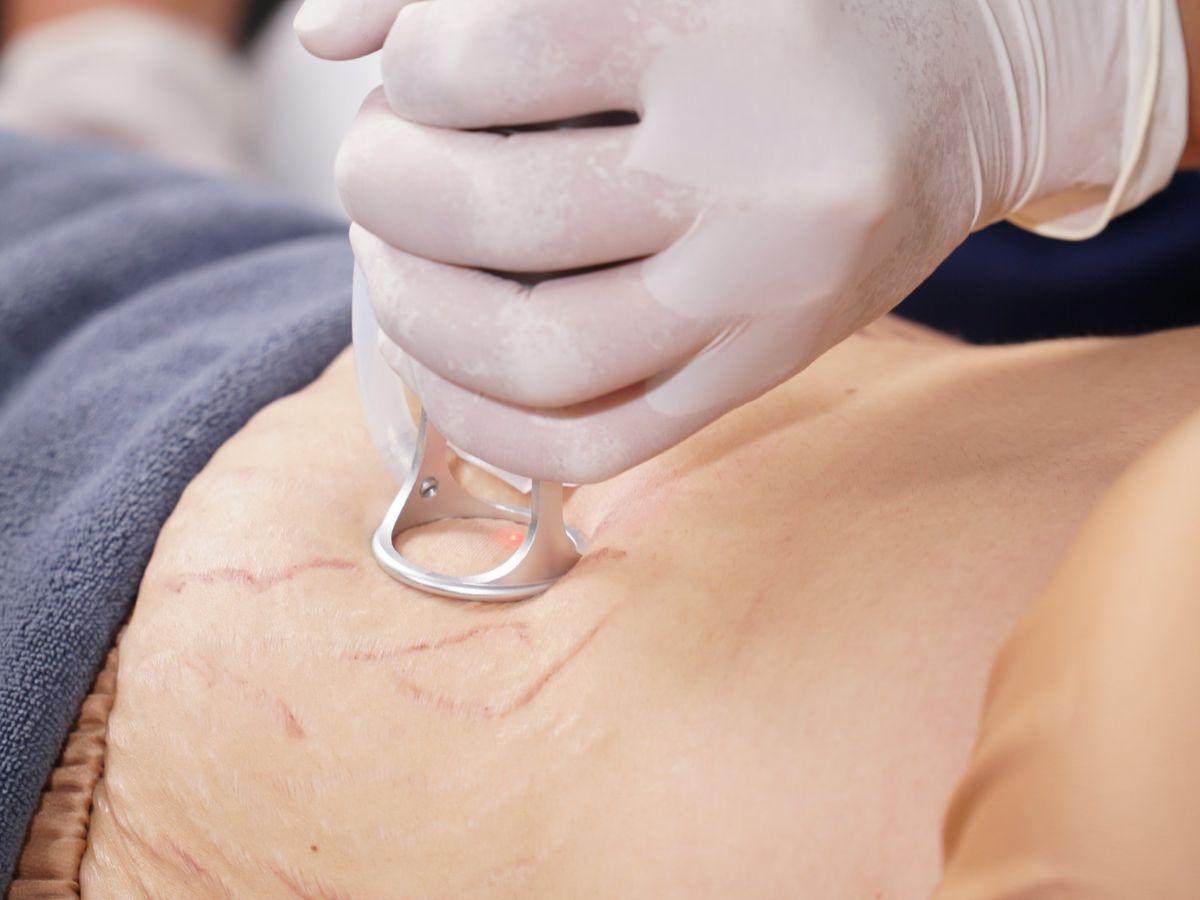 Xoá rạn da bằng laser