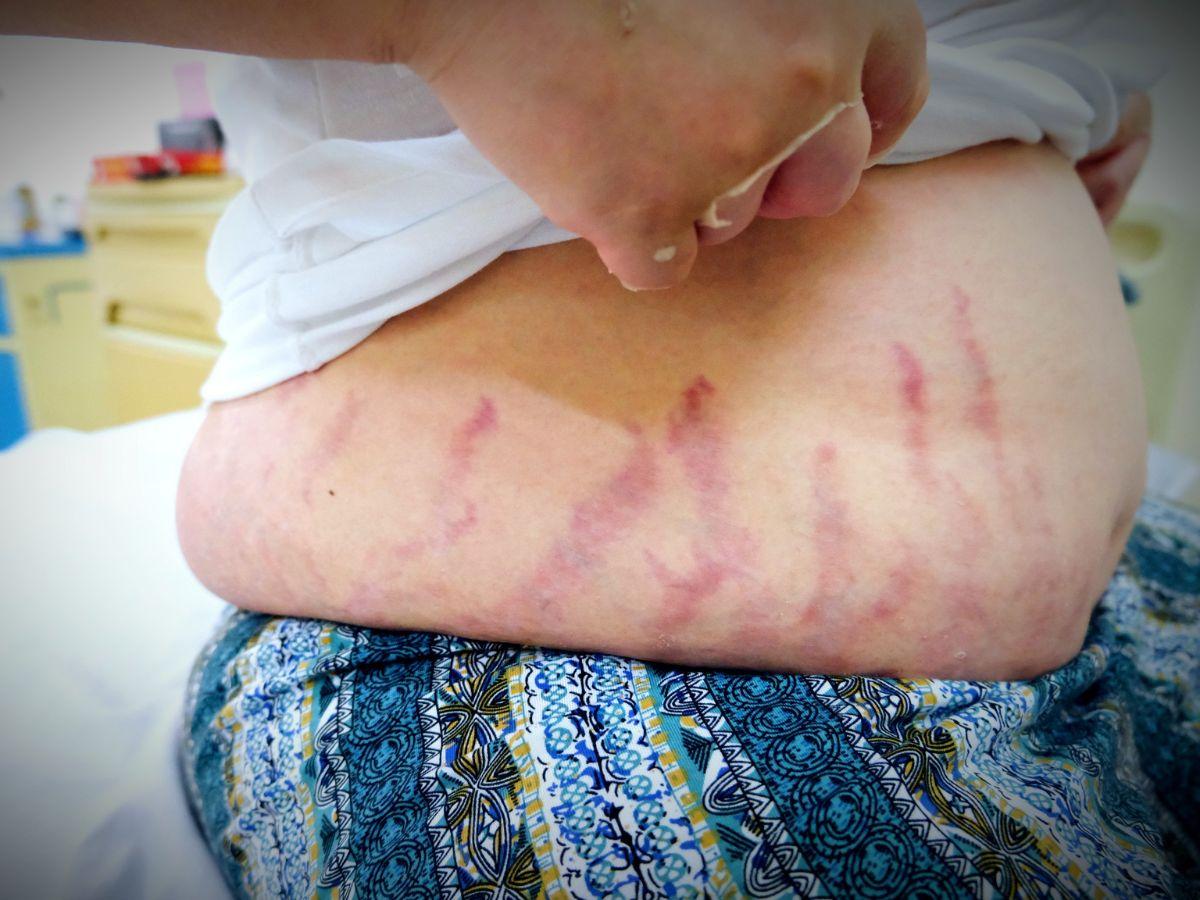 Rạn da do dùng thuốc có steroid