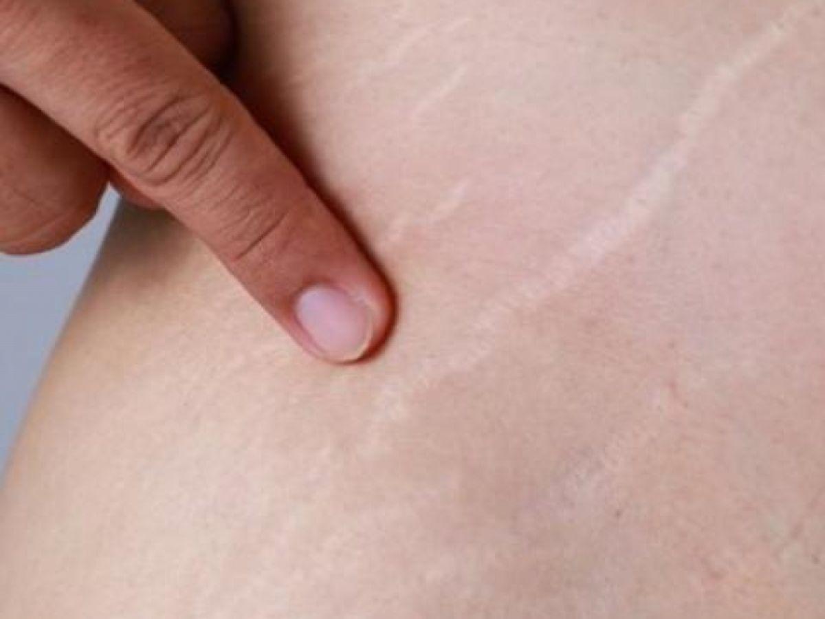 Rạn da do tăng hoặc giảm cân nhanh