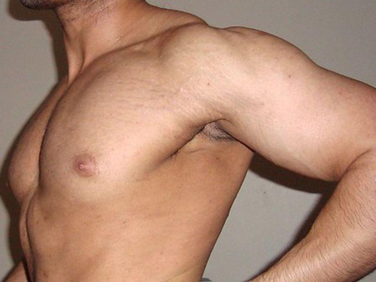 Rạn da không nguy hiểm