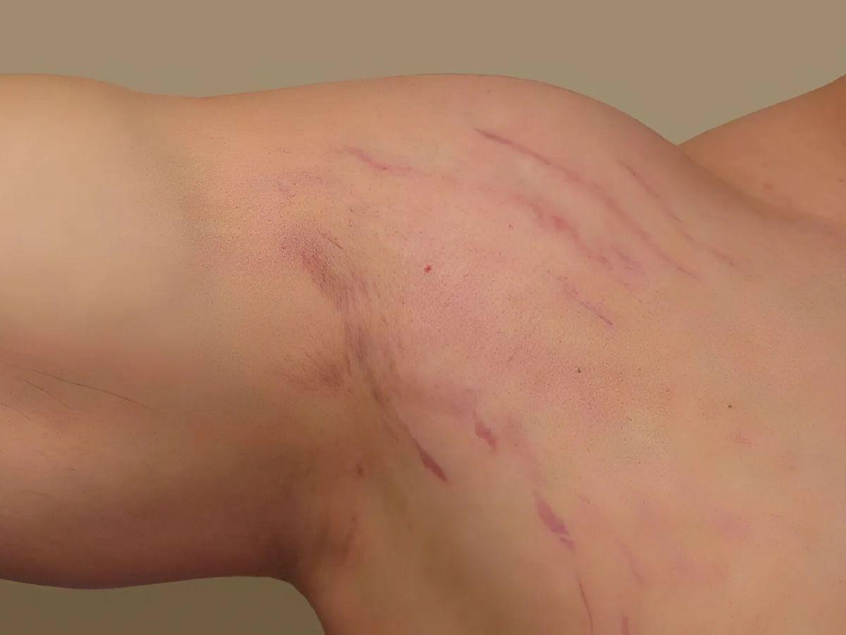 Dậy thì có thể gây rạn da