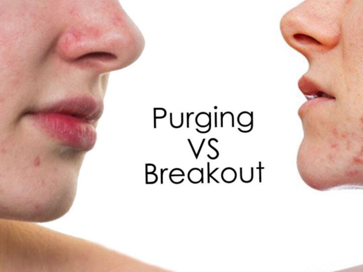 Phân biệt purging và breakout