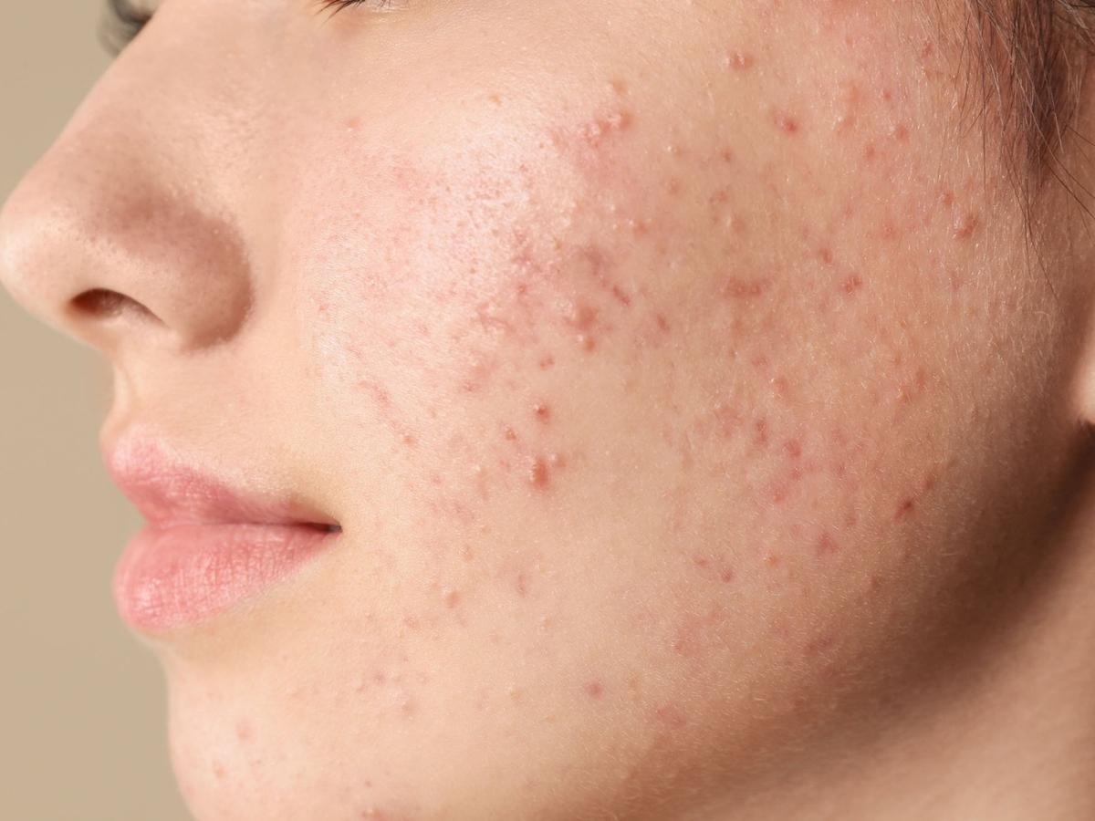 Chăm sóc da mụn cẩn thận để phục hồi hiệu quả