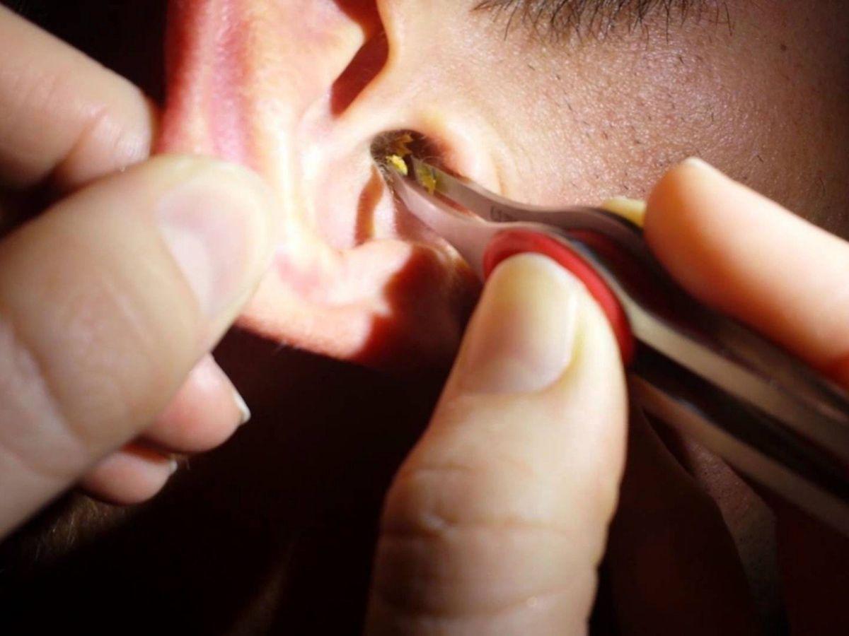 Nguy cơ nhiễm trùng tai do vệ sinh tai nghe kém