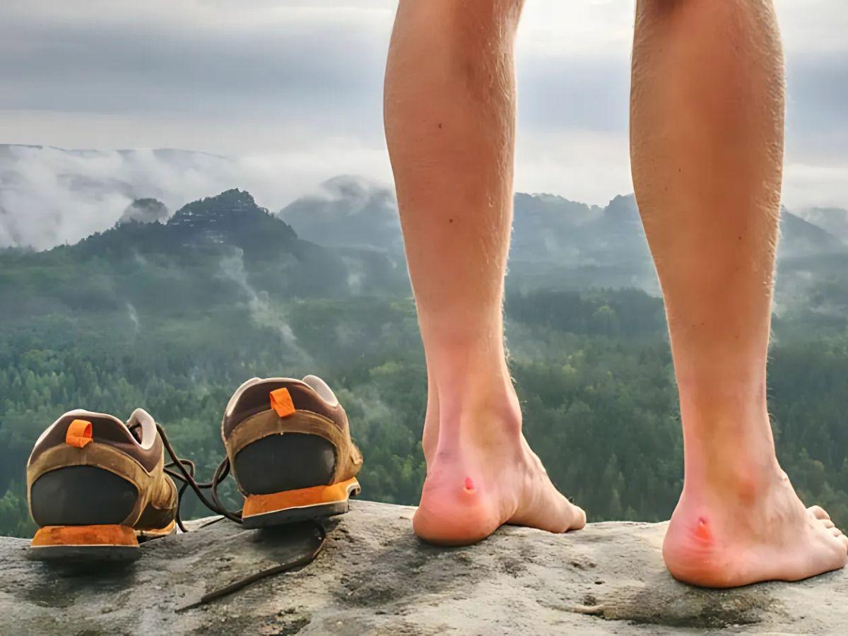 Phồng rộp chân khi chạy bộ. Nguồn: Internet