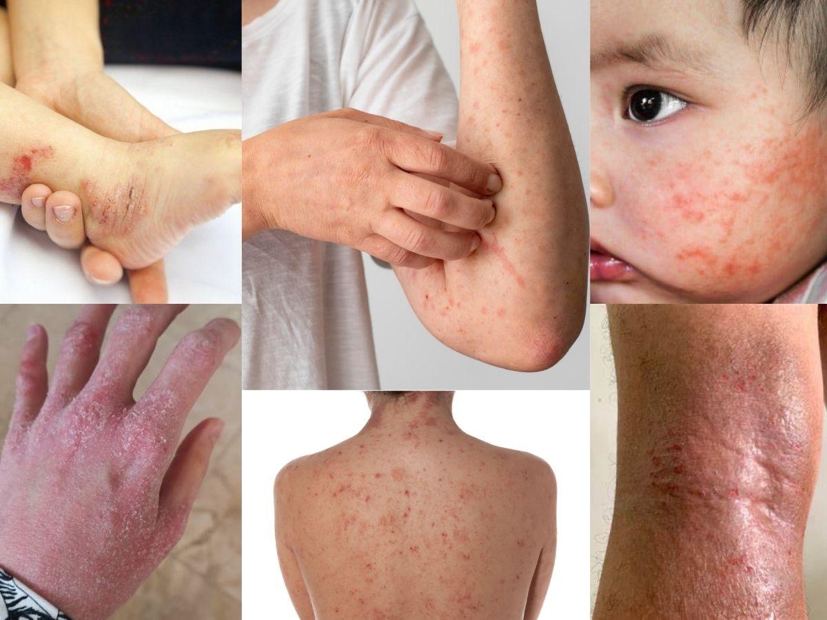 Viêm da cơ địa là gì? Nguyên nhân, biểu hiện 