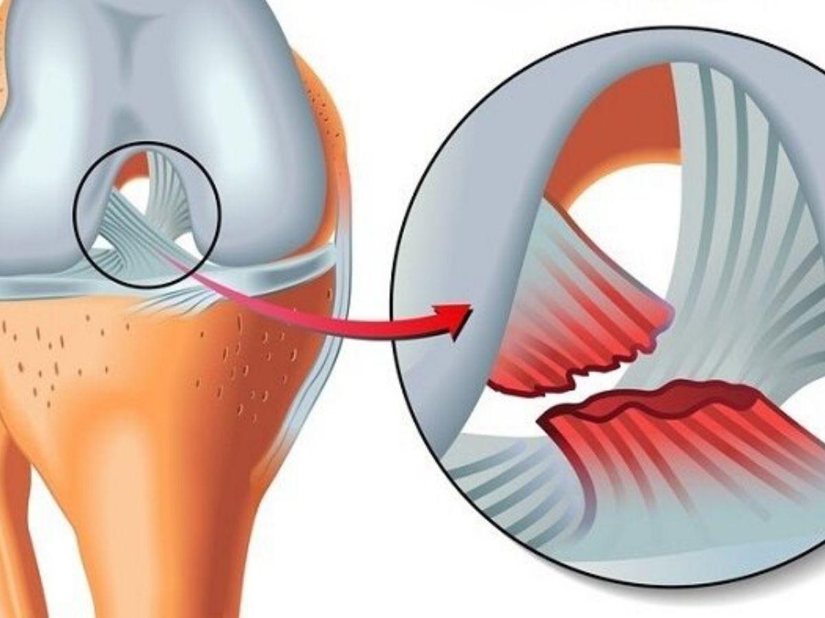 Chấn thương dây chằng chéo trước