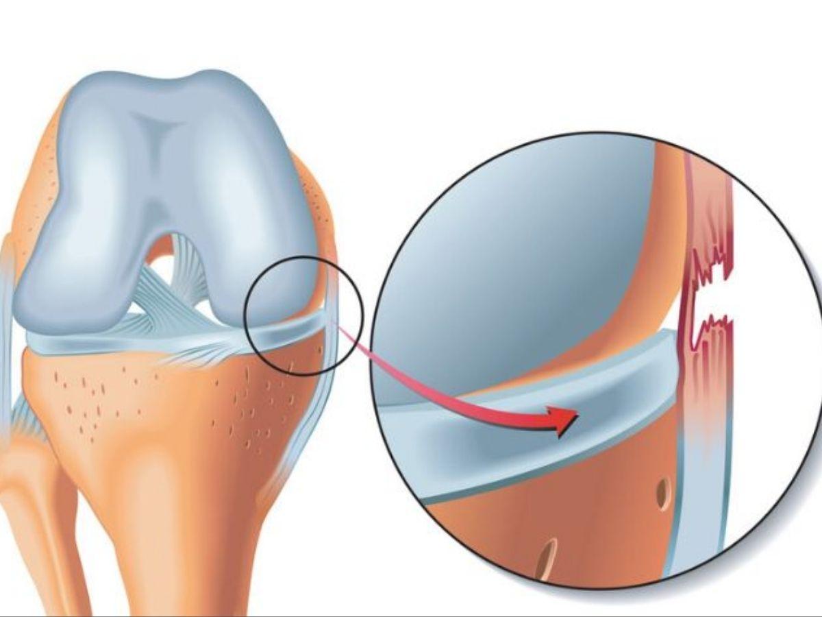 Chấn thương dây chằng đầu gối trong