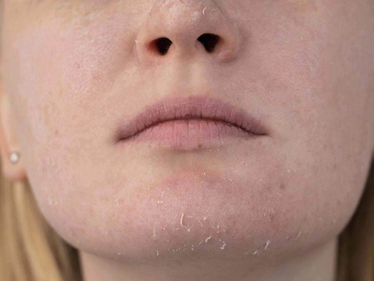 Da khô là tình trạng da bị thiếu độ ẩm do mất nước ở lớp biểu bì