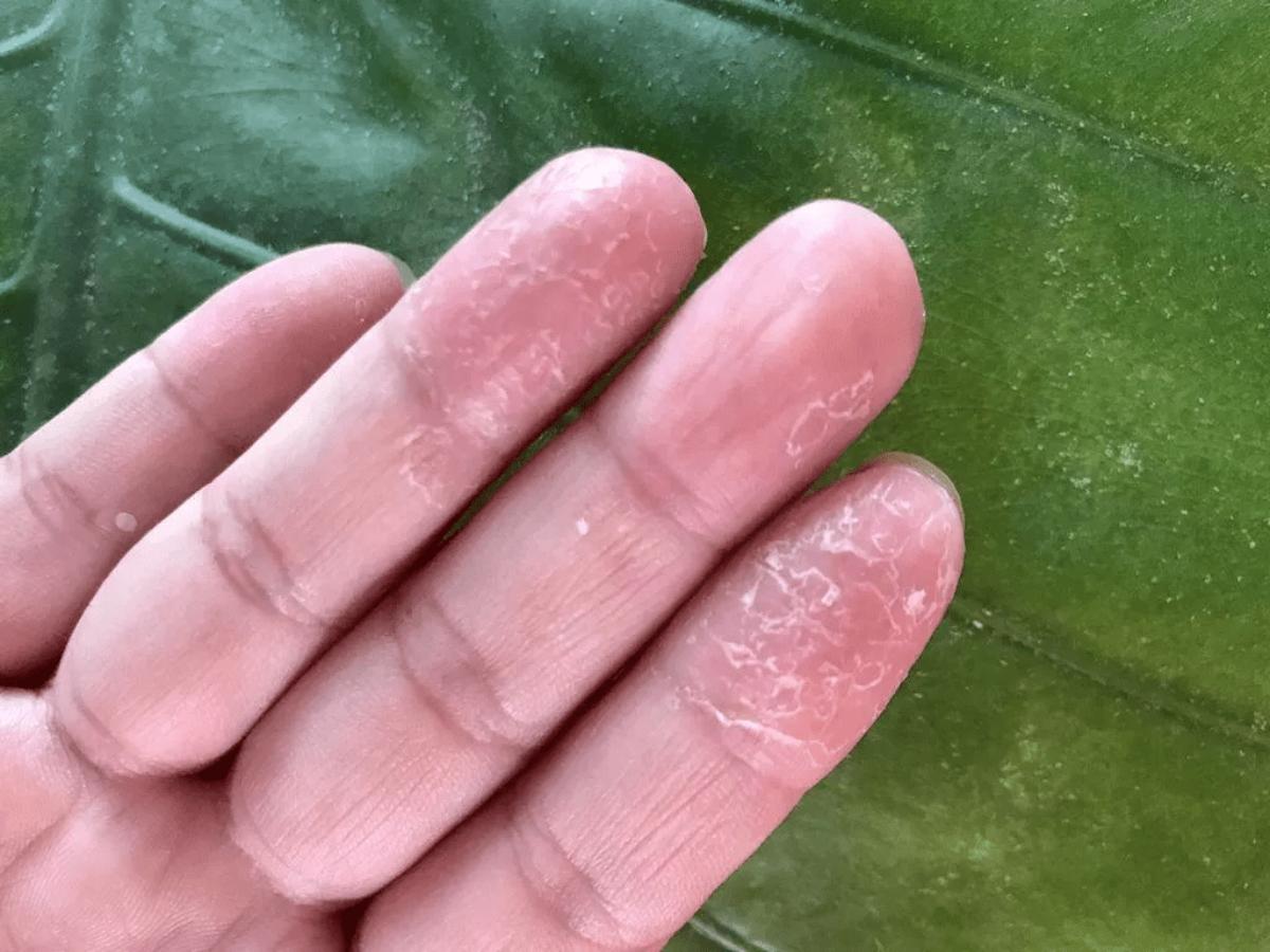 Triệu chứng lột da tay là khô, bong tróc