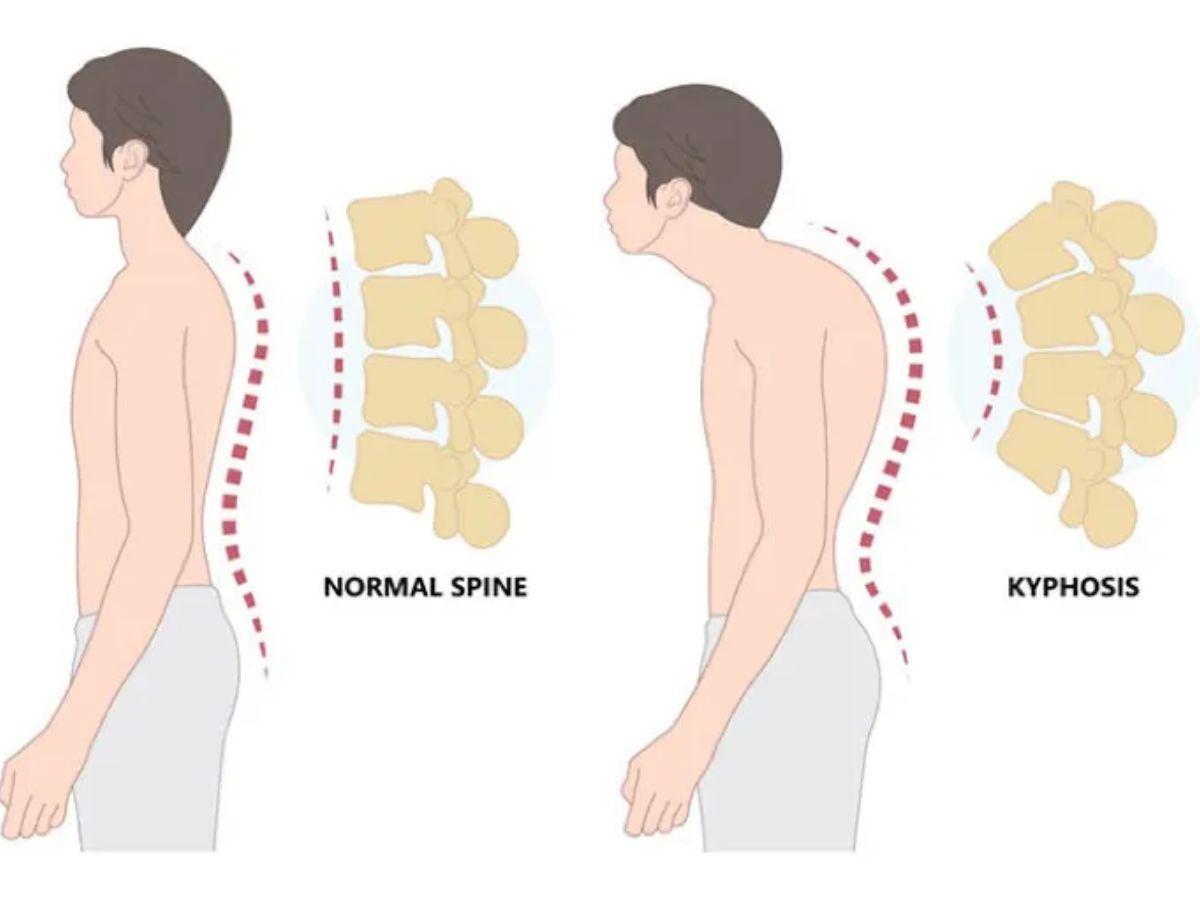 Lý do người bị gù lưng cần tập trung vào vai sau & lưng trên