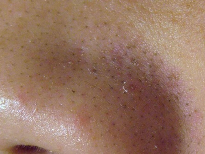 Tuyến bã nhờn hoạt động mạnh gây lỗ chân lông to