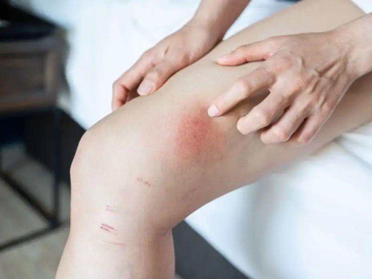 Các dấu hiệu bị Chafing là gì?