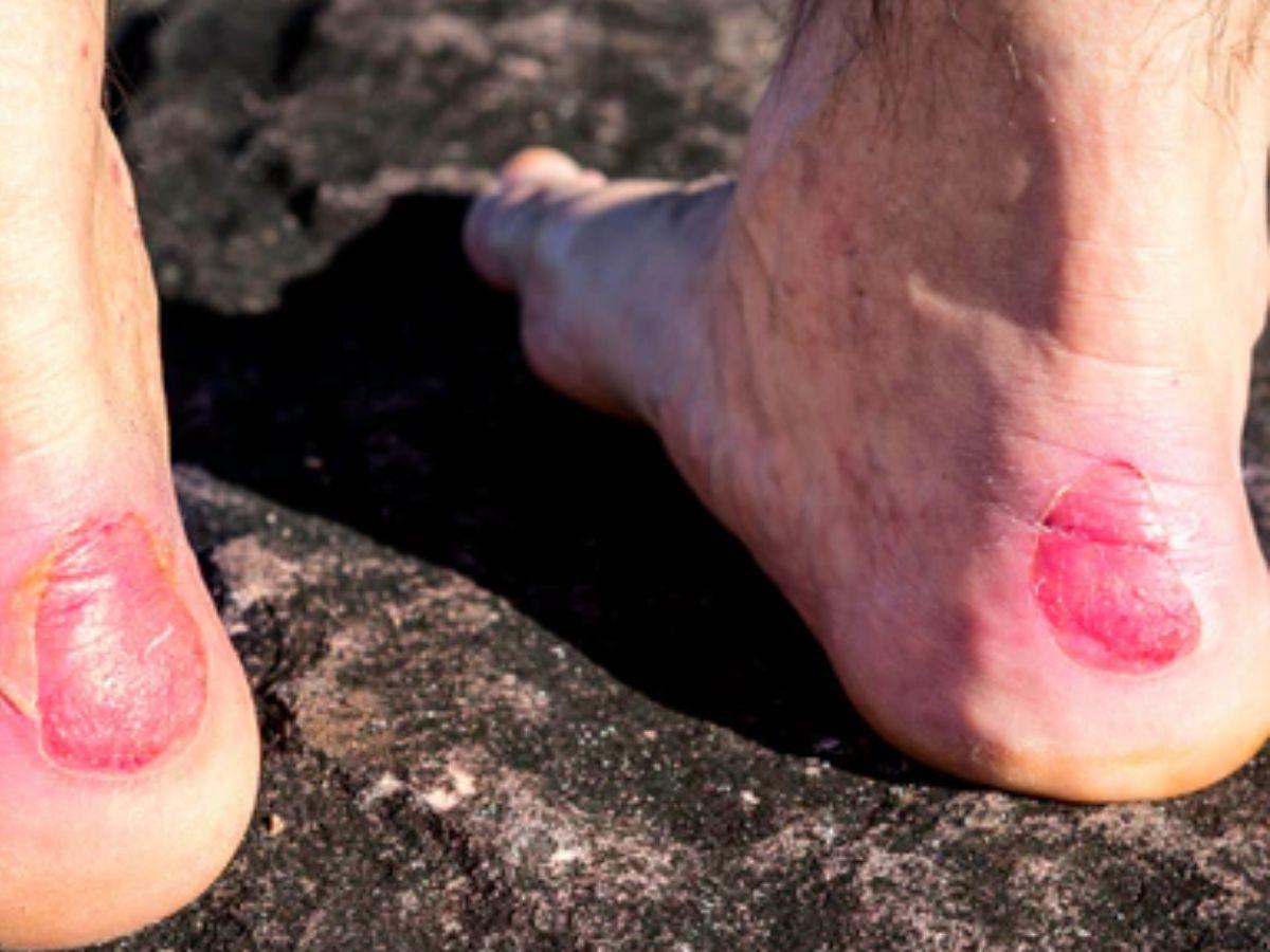 Các dấu hiệu bị Chafing là gì?
