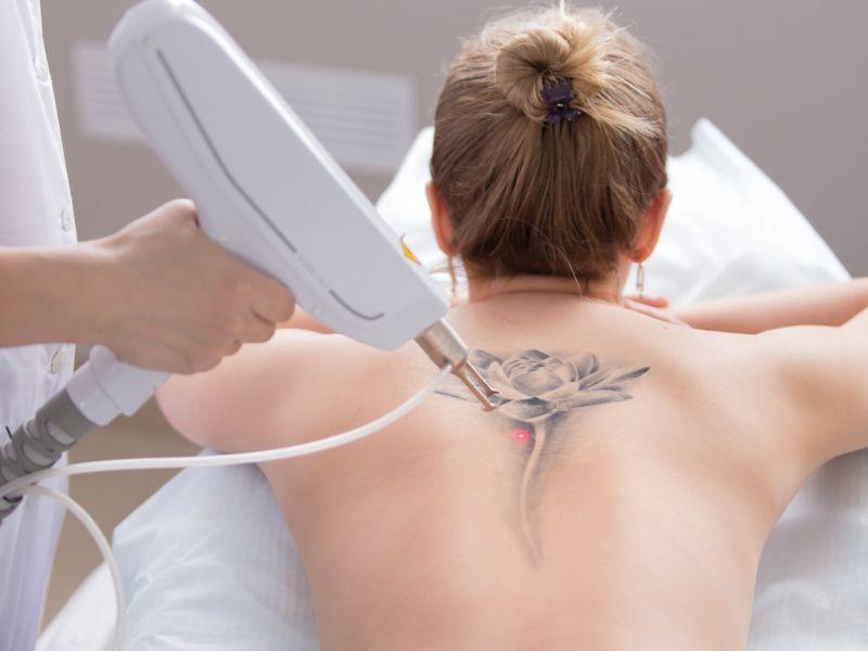 Không cần dùng biện pháp đau đớn để xóa hình xăm