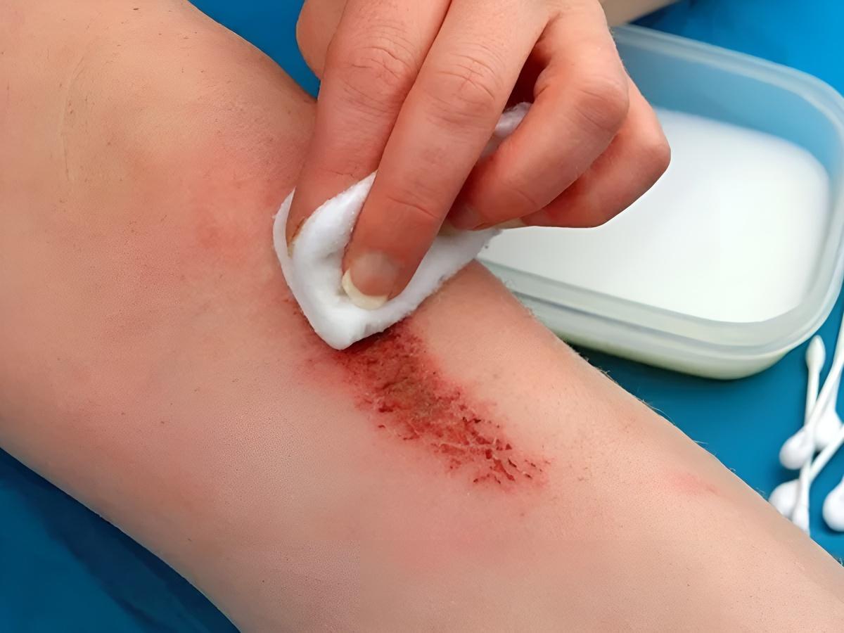 Tuyệt đối không xuống nước với vết thương hở