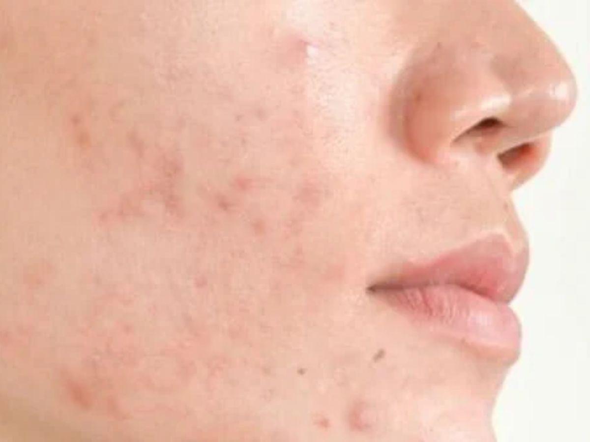 Giai đoạn phục hồi ban đầu