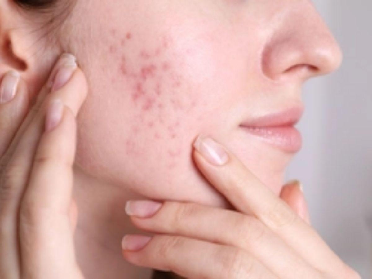 Giai đoạn Phục hồi sâu và Ngừa thâm