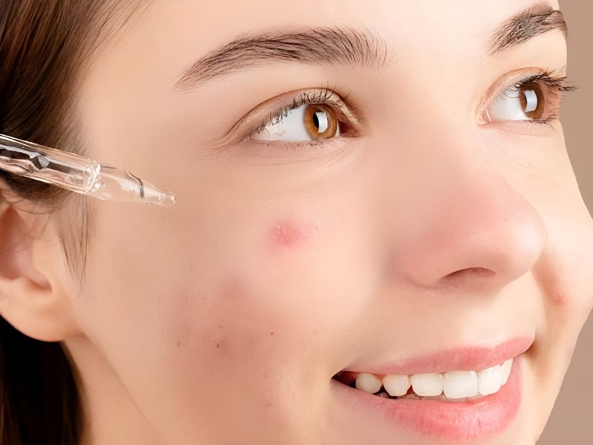 Có cần dùng serum cho da dầu mụn không?