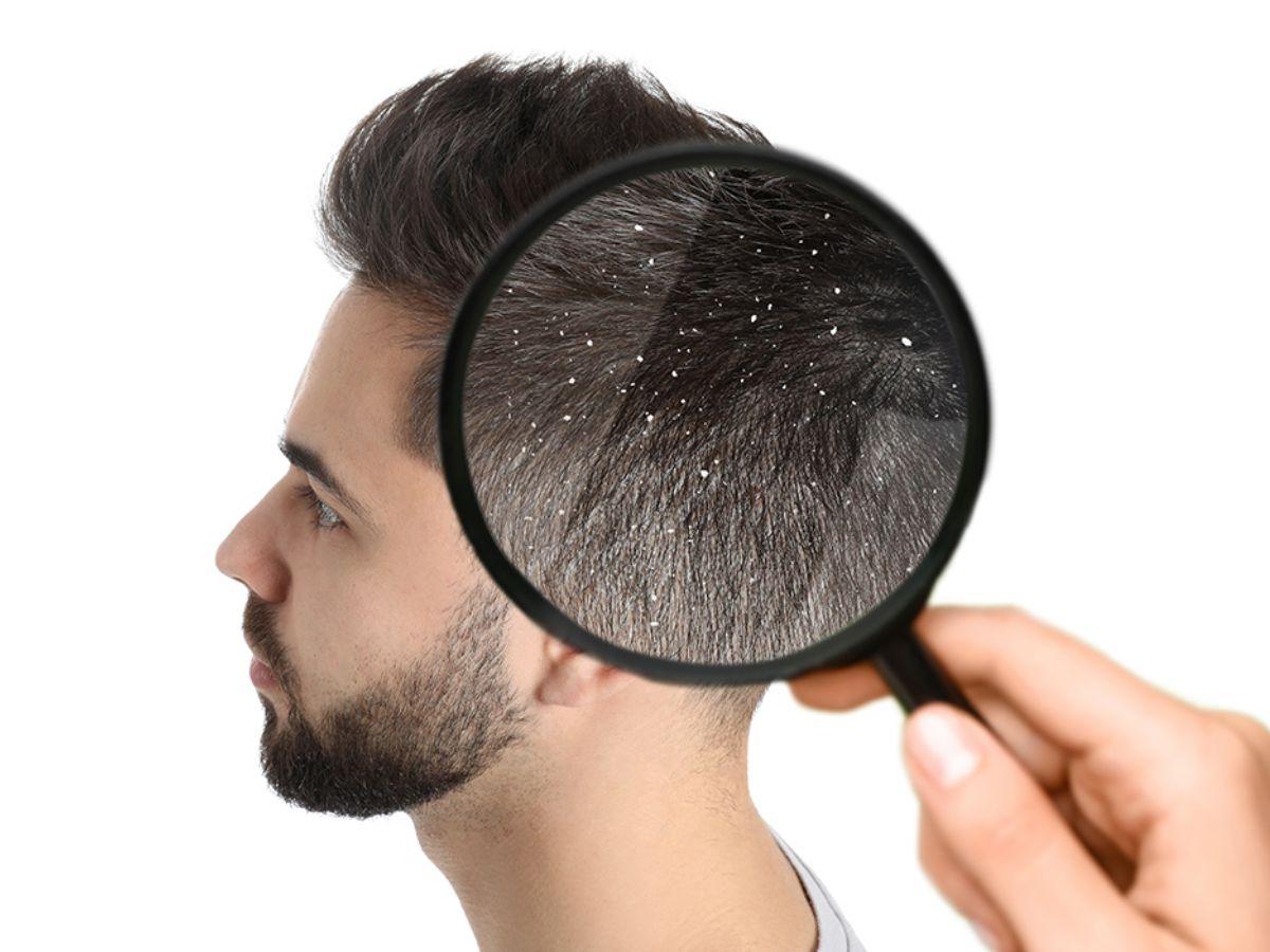 Tóc gàu có thể do nấm hoặc dị ứng với các sản phẩm chăm sóc tóc