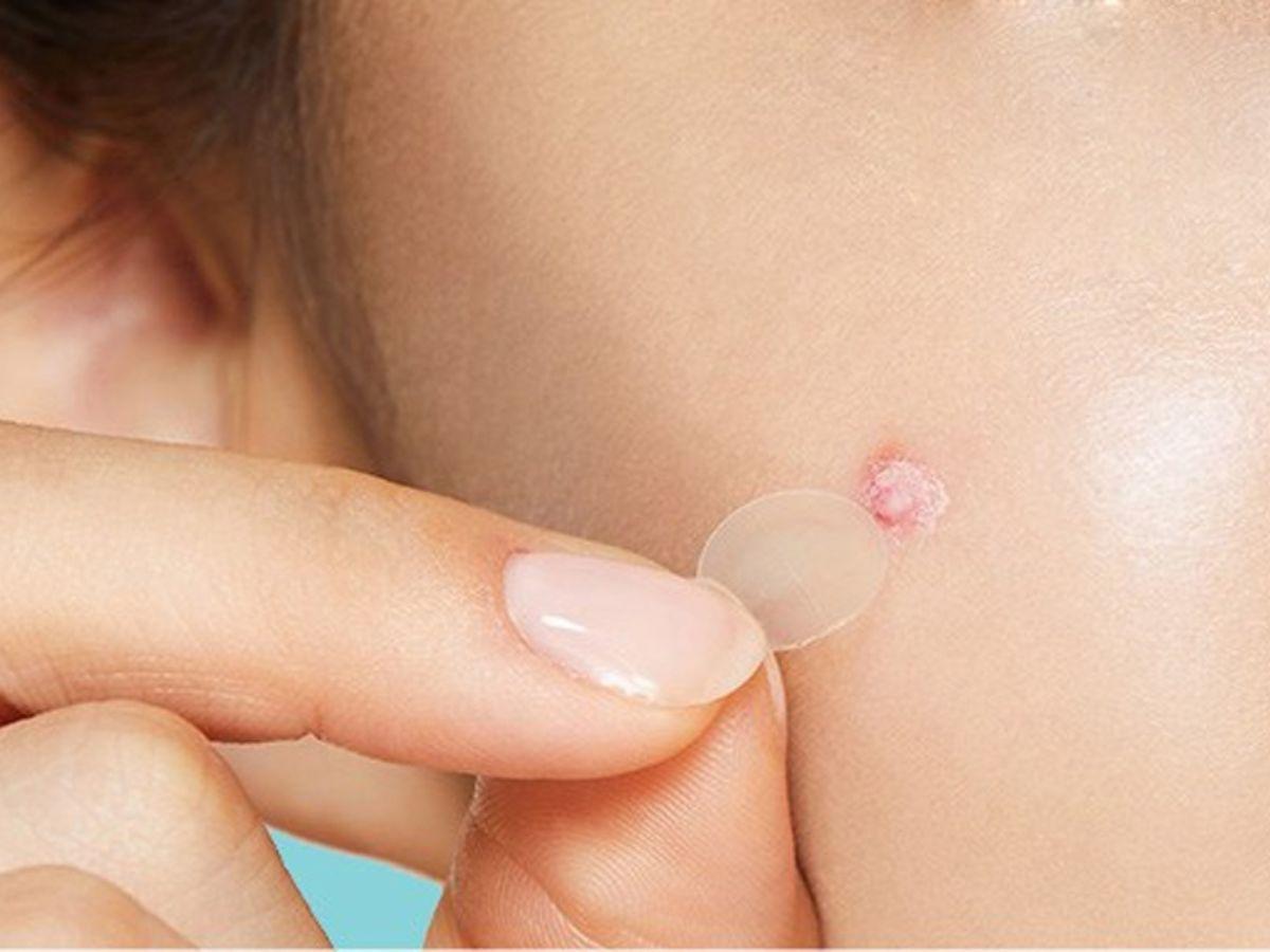 Miếng dán mụn thường làm từ hydrocolloid