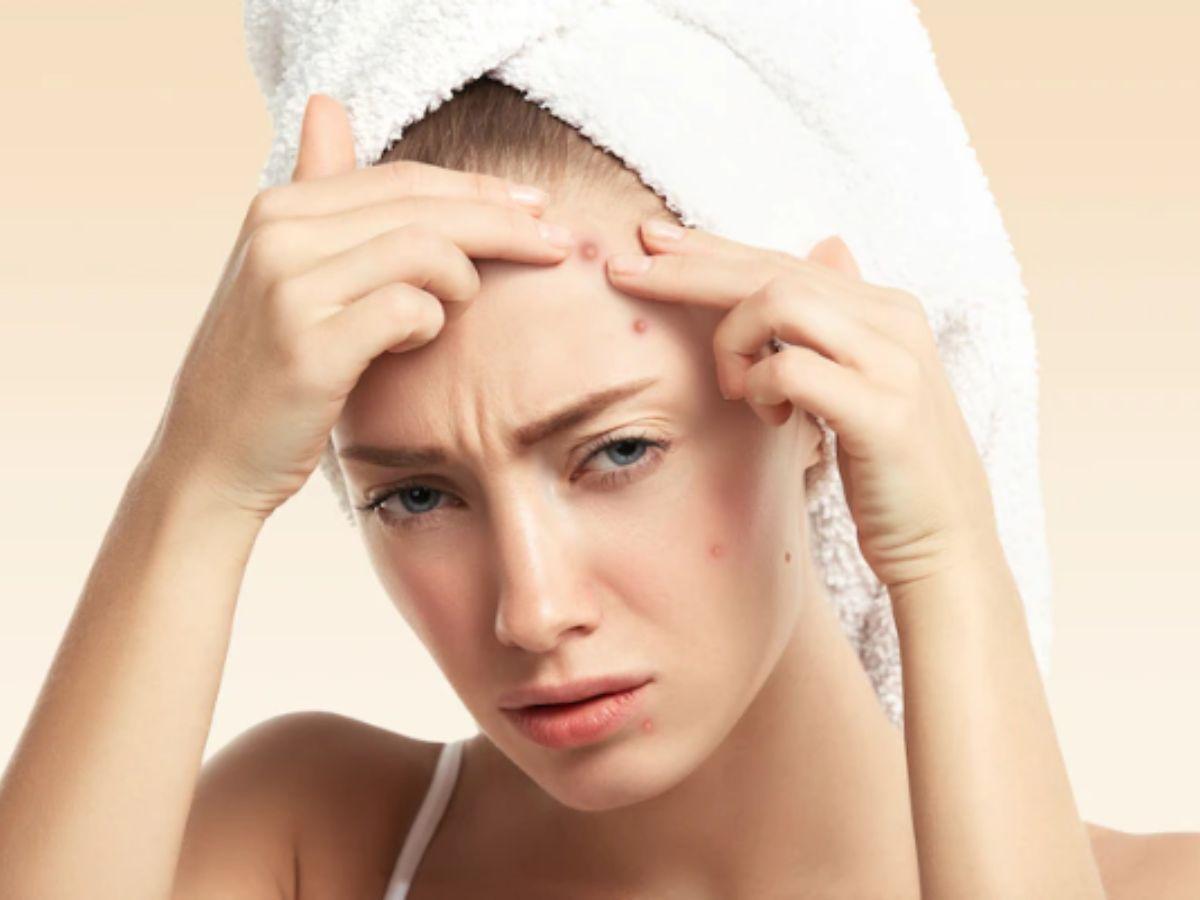 Nặn mụn sai cách dễ gây viêm nhiễm nặng hơn, để lại sẹo rỗ