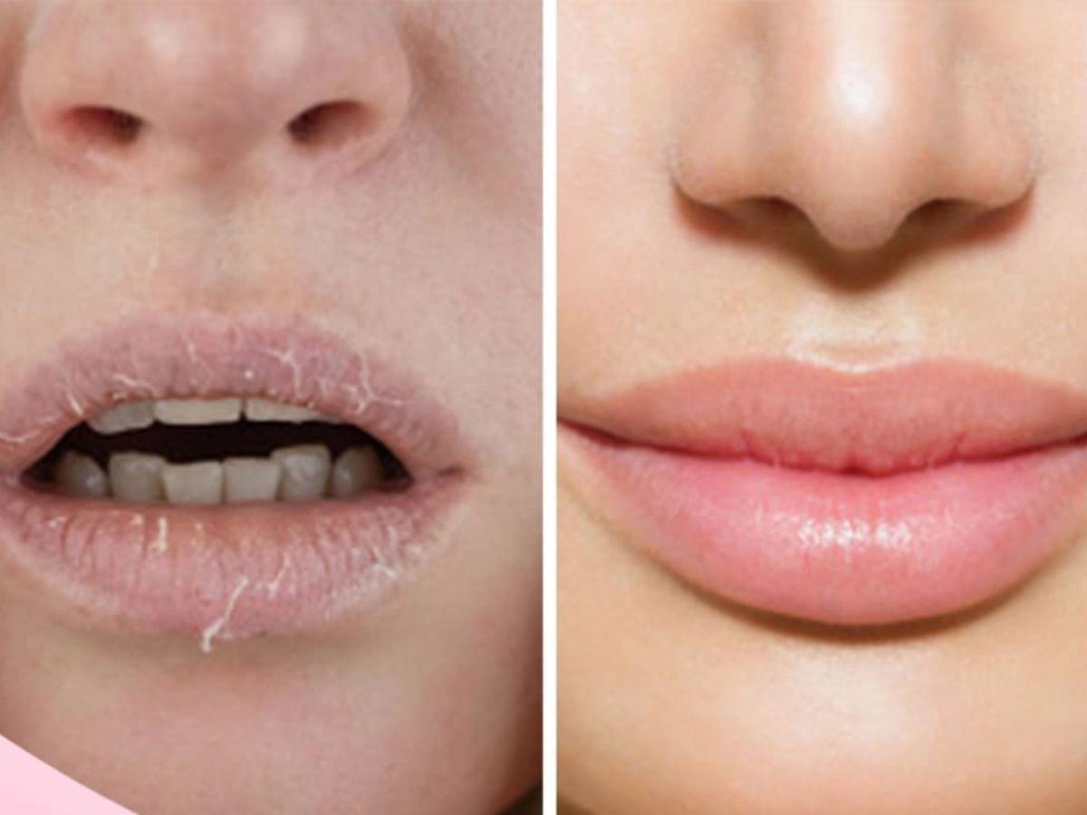 Môi Khô Nứt Nẻ Là Do Đâu?