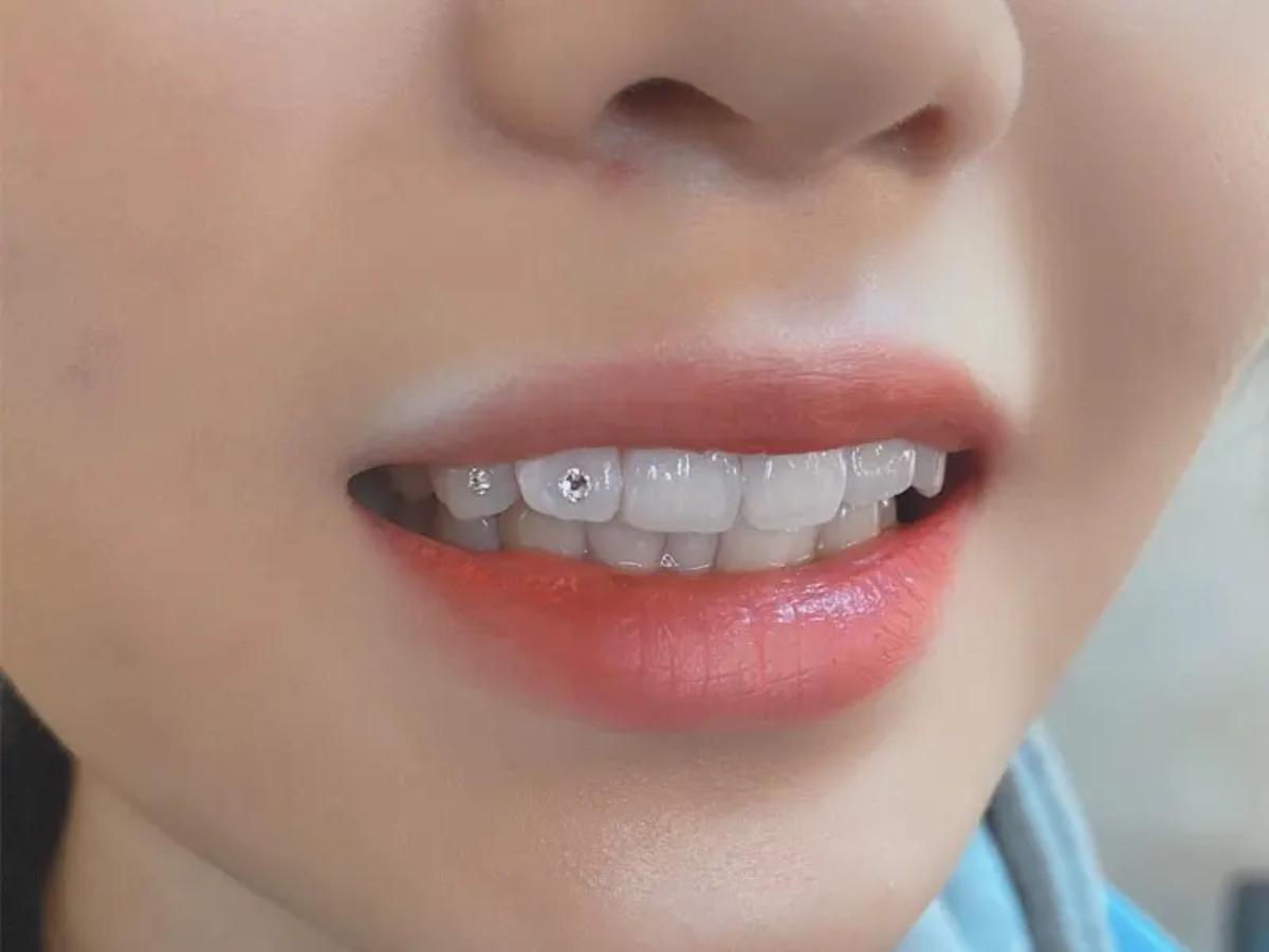 Đối tượng có thể thực hiện đính đá răng