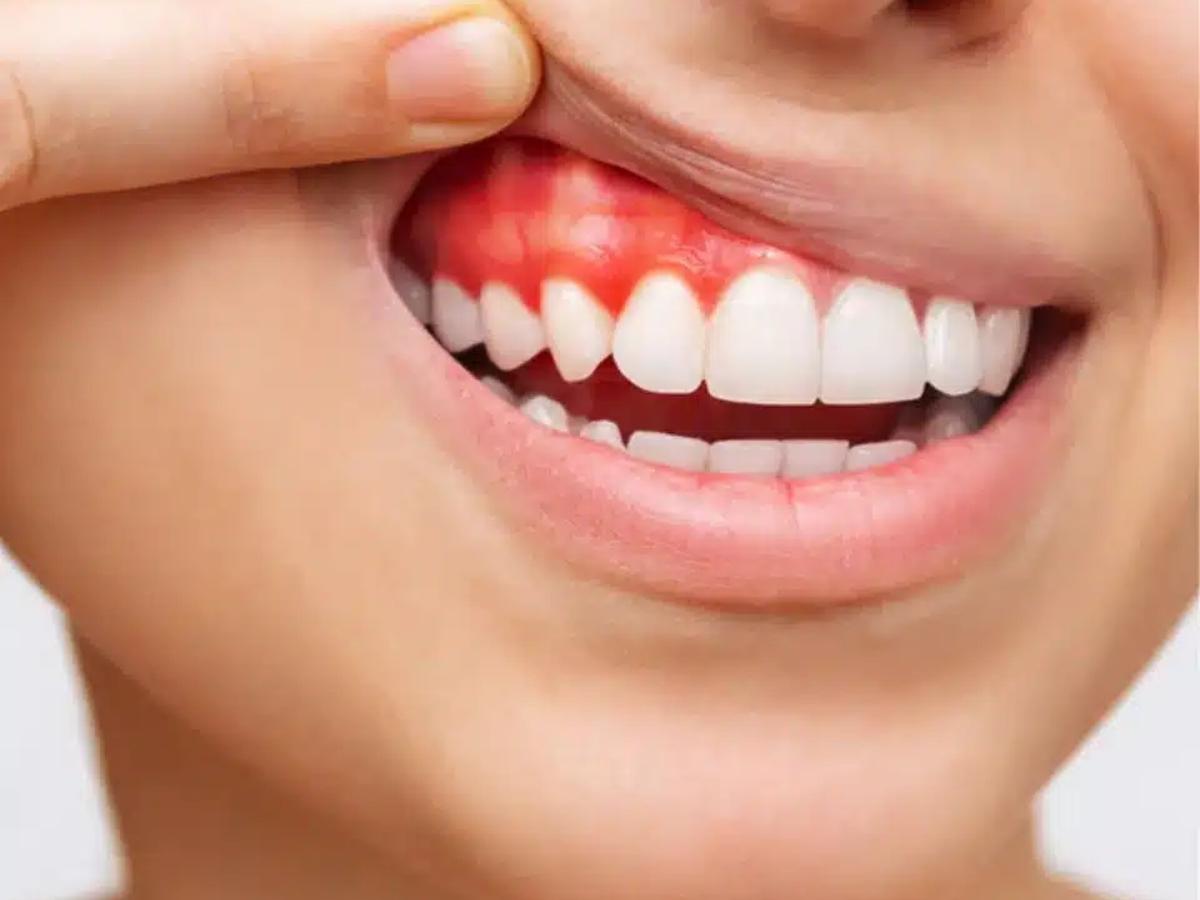 Một vài người không nên thực hiện đính đá răng 