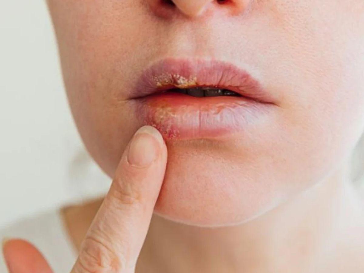 Đôi môi bị khô, bong tróc nhẹ do kích ứng mỹ phẩm