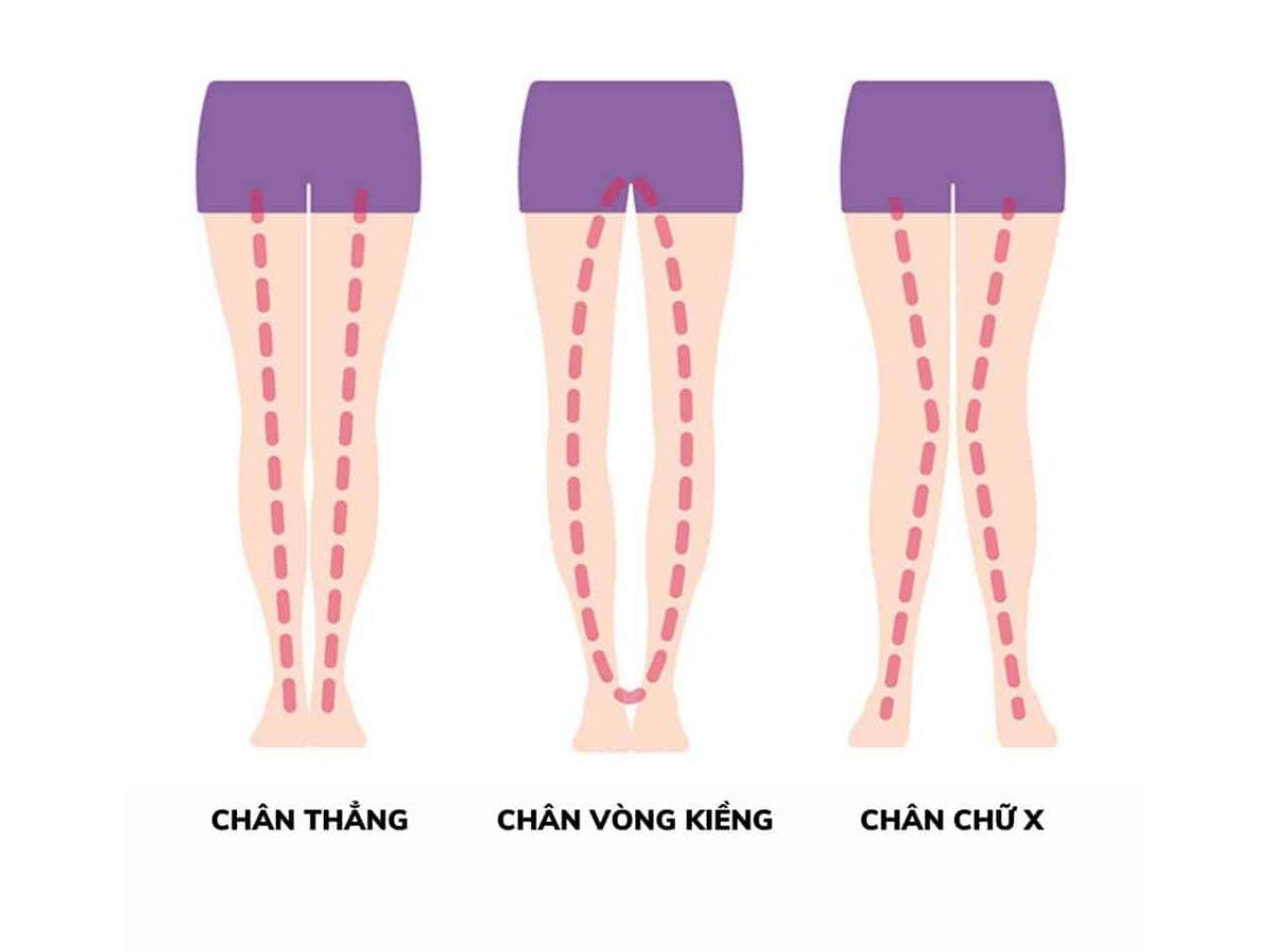 Chân vòng kiềng tạo thành hình chữ O và có khoảng cách giữa 2 chân khi đứng thẳng
