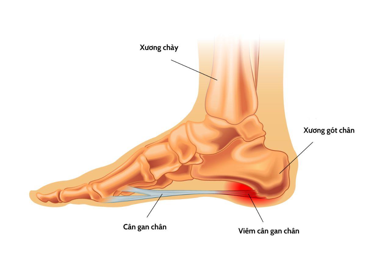 Các vấn đề viêm gân, viêm khớp có thể ảnh hưởng đến hoạt động chạy bộ