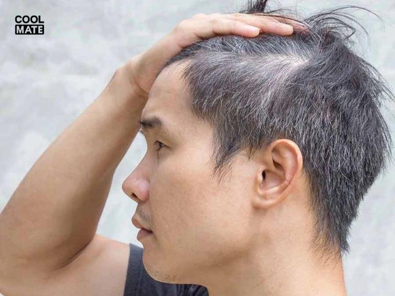 Nguyên nhân tóc bạc sớm ở nam giới