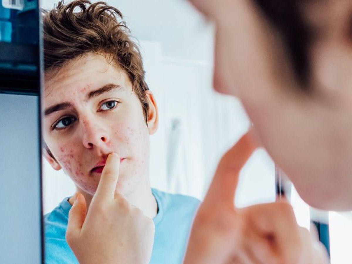 Da nam giới có những đặc điểm riêng hình thành lên mụn