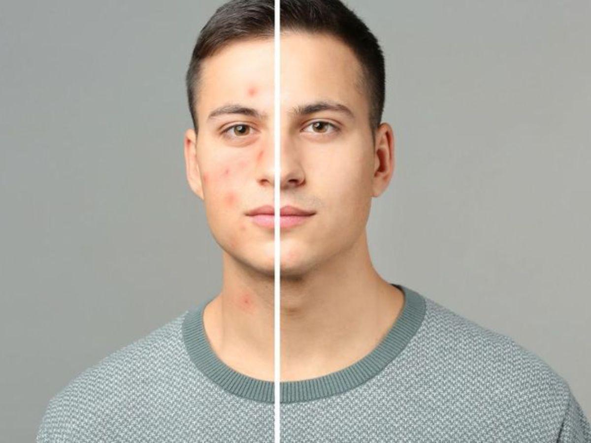 Toner trị mụn là một công cụ hữu ích trong việc cải thiện làn da mụn