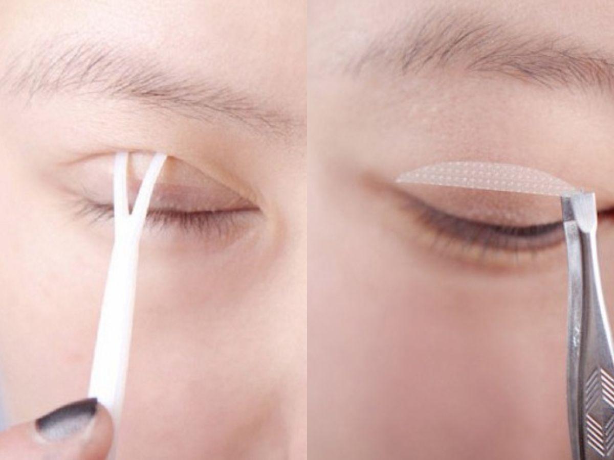 Có thể dùng phương pháp kích mí để hạn chế tình trạng sụp mí