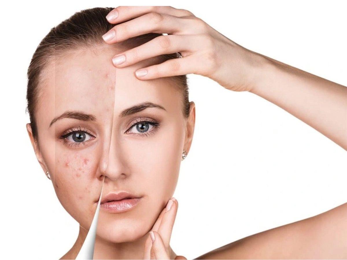 Hiệu quả của việc trị mụn ẩn còn tùy thuộc vào từng loại da