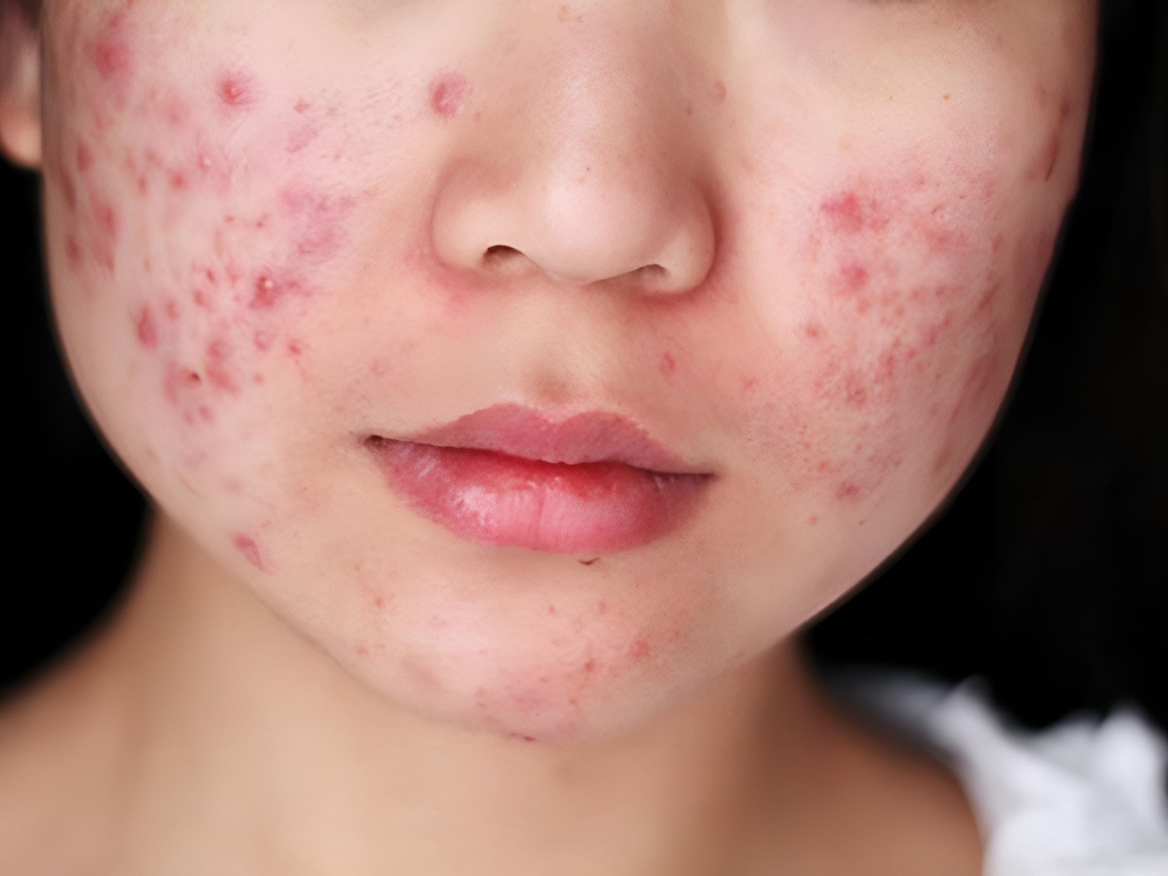 Mụn trứng cá không chỉ là những nốt mụn xấu xí mà thực chất là bệnh về da