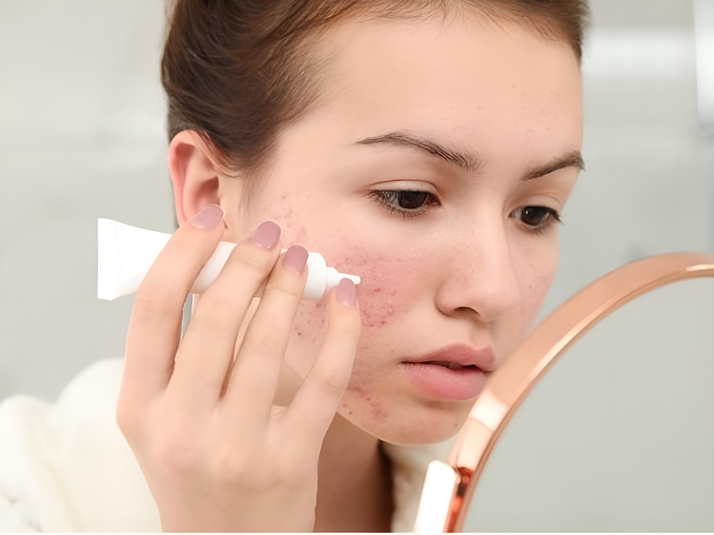 Nên thoa treatment lên vùng da cần điều trị