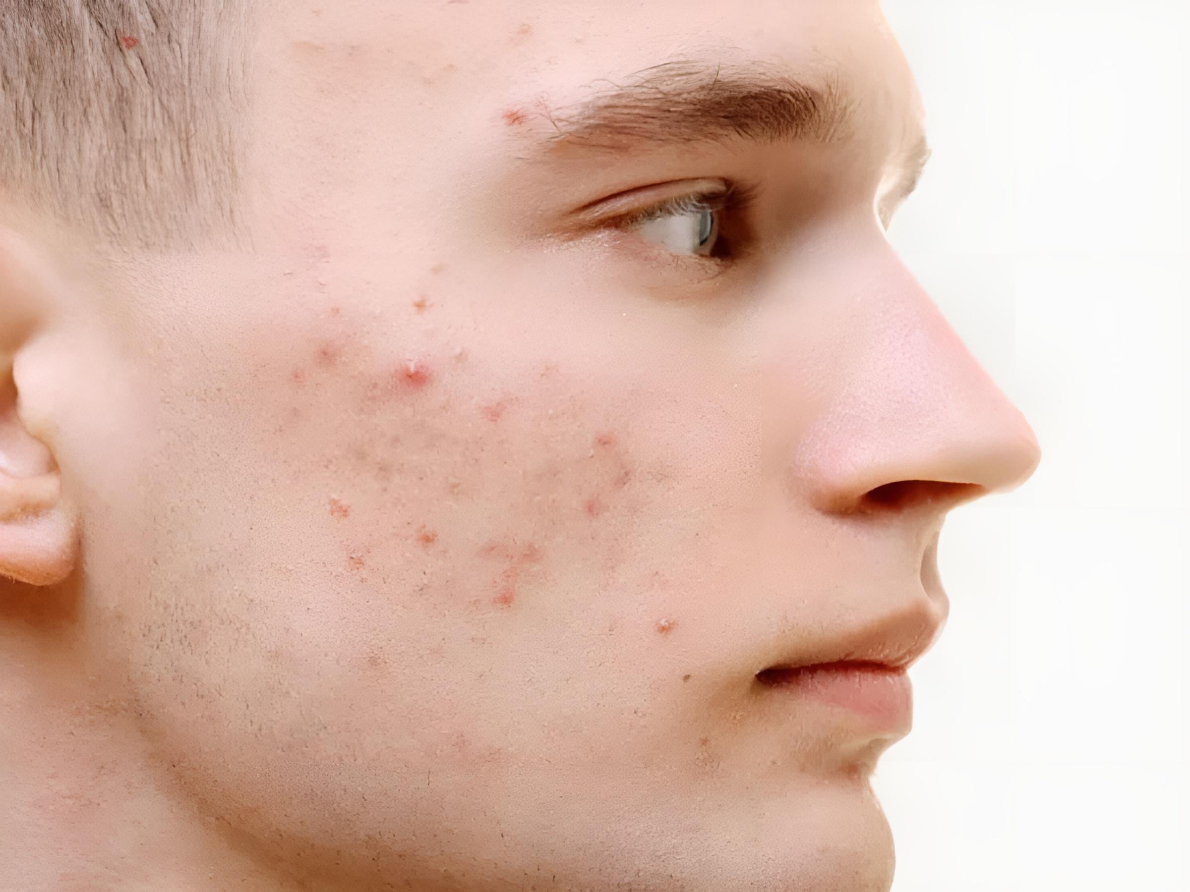 Cách trị mụn trứng cá cho nam giới có khác nữ giới không?