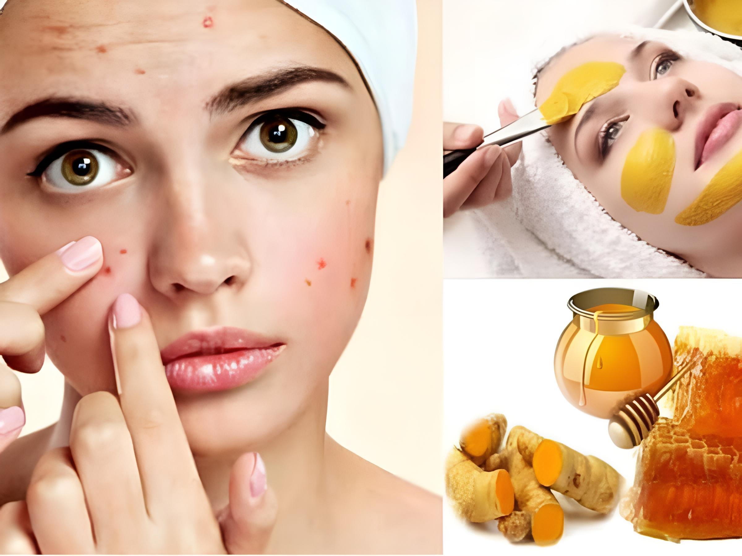 Công thức này được nhiều người tin dùng vì vừa trị mụn, vừa ngừa sẹo thâm khó chịu
