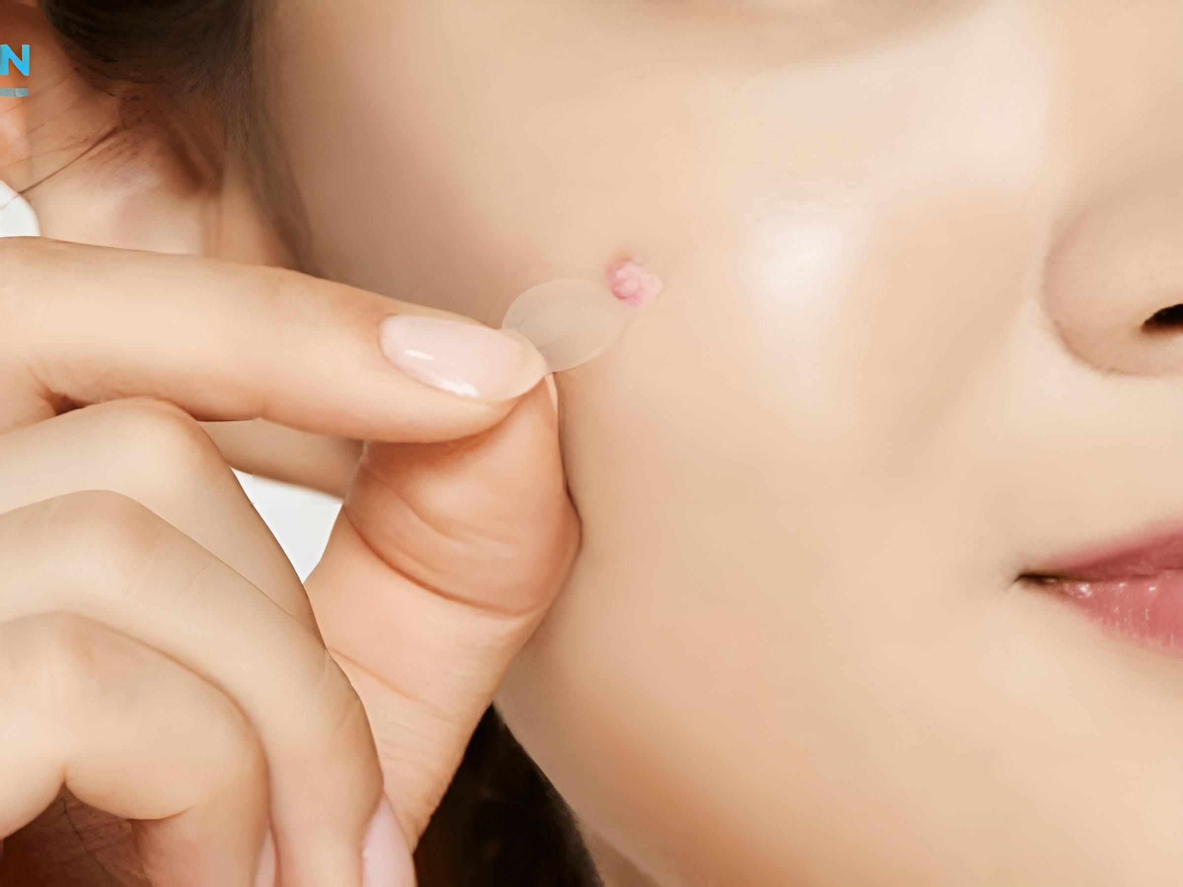 Miếng dán mụn chính là vệ sĩ tí hon cho các nốt mụn sưng viêm