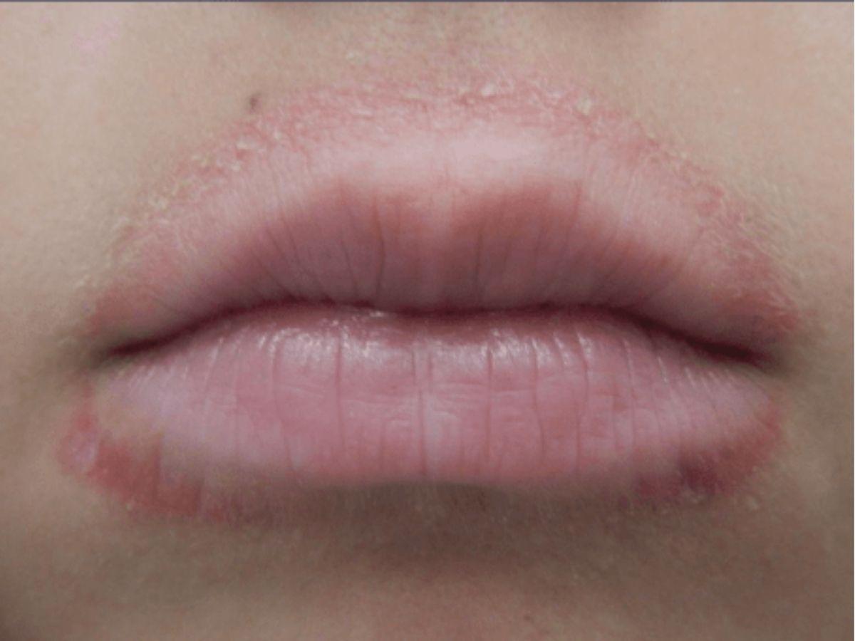 Dị ứng son môi là gì?