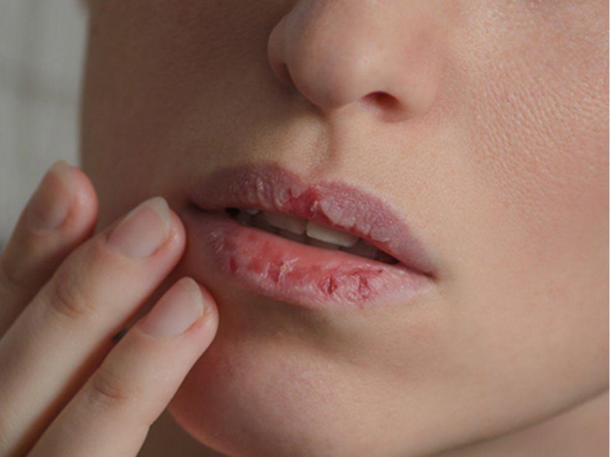 Phân loại cấp độ dị ứng son môi