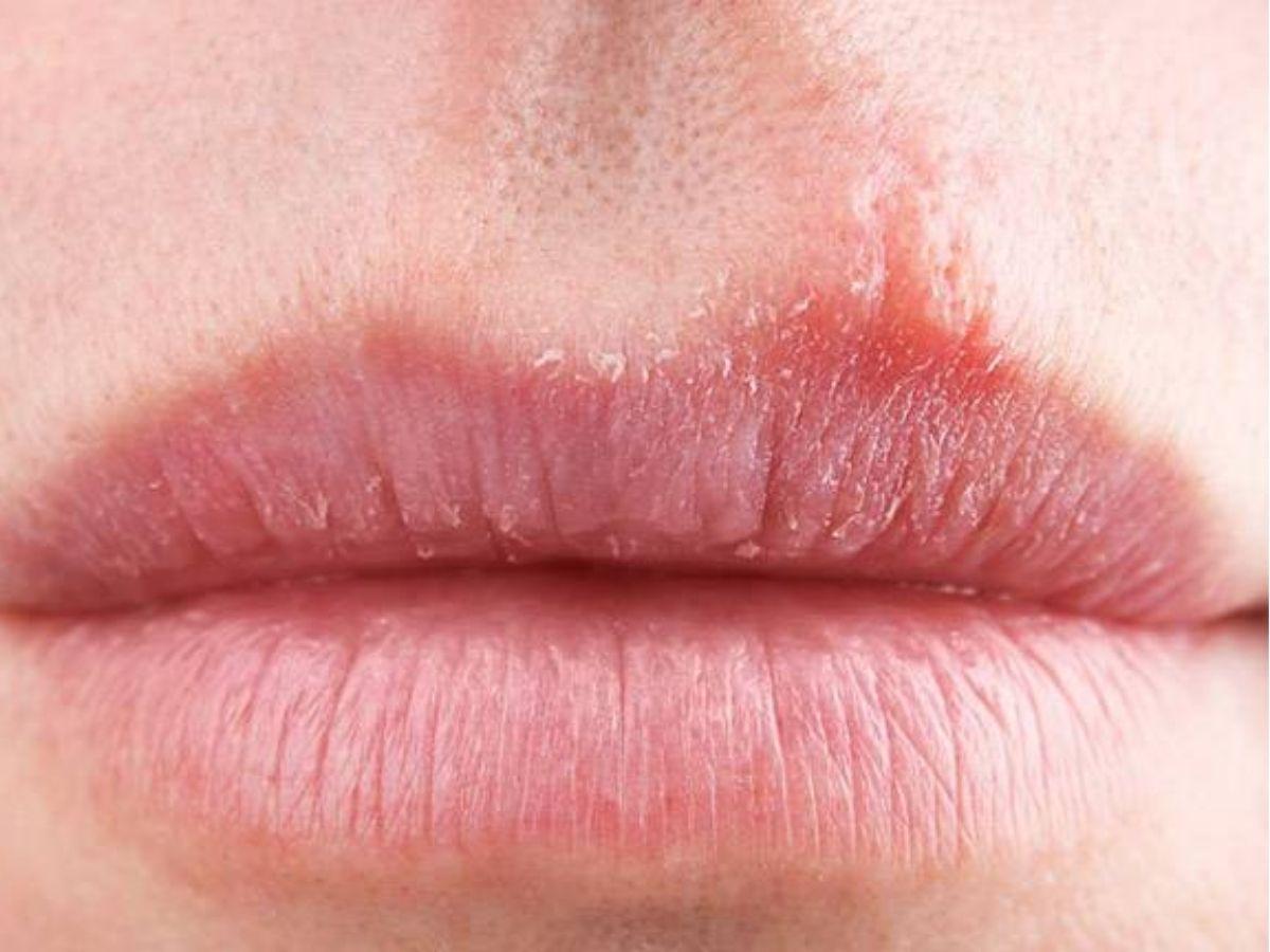 Dấu hiệu bị dị ứng son nhẹ nhàng